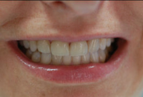 The image is of a smiling woman with white teeth and lipstick, showing her teeth.