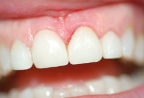 The image shows a close-up of a person s mouth with teeth, featuring an upper denture with visible wear and a lower set of natural teeth.