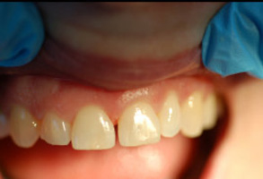 This image shows a close-up of a person s teeth with a focus on the lower front teeth, which appear to be in need of dental care. The individual is wearing gloves and there is blue medical tape visible, suggesting that this could be a dental professional s office or during a dental procedure.