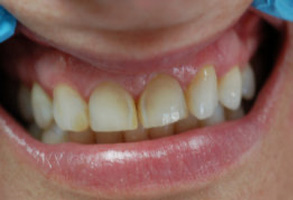 The image displays a close-up of a person s smiling face with teeth that appear to be in need of dental care, specifically cleaning or whitening.