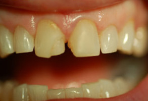 An extreme close-up of a person s mouth with multiple teeth missing, revealing the inner oral cavity and gum line.