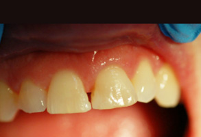 The image shows a close-up of a person s mouth with teeth and gums, with the focus on an area of dental work or repair.