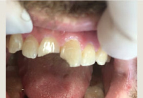 The image shows a close-up of an individual s mouth with severely decayed teeth, some missing or broken, and the presence of a medical professional s gloved hand holding a dental instrument.
