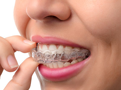 The image shows a person holding a clear retainer or mouthguard, which is typically used for orthodontic purposes.