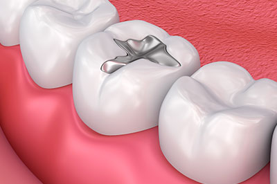 Alt text  Image of a dental implant in the midst of a set of teeth, with a focus on the surgical fixture.