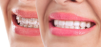 The image is a composite of two photos, one showing a person s face with a smile and the other showcasing teeth whitening products.