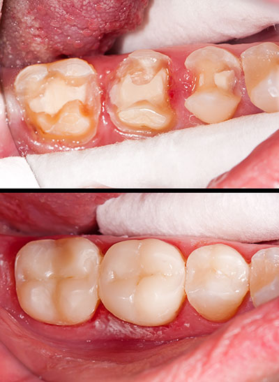 The image displays a close-up of a person s mouth with teeth that appear to be in poor condition, showing signs of decay and gum disease. The lower part of the image shows the same mouth after dental treatment, revealing improved oral health with cleaner teeth and gums.