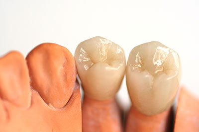 This is an image of a set of dental implants with crowns, showcasing the upper and lower teeth structures.