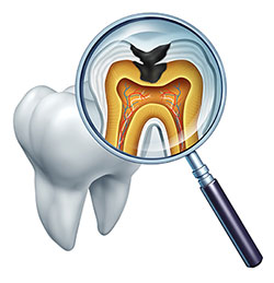 The image shows a magnified view of a tooth with an open crown, revealing the inner structure and a cavity, viewed through a magnifying glass.