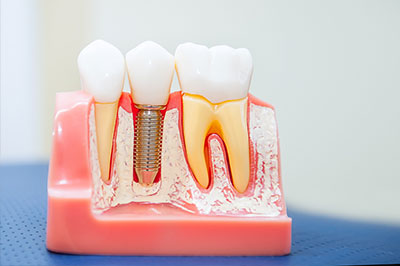 The image shows a model of a human mouth with multiple teeth, including some that appear to have fillings or crowns, and an implant visible at the bottom.