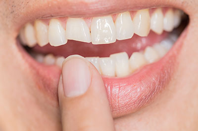 The image shows a close-up of a person s mouth with teeth, holding a finger near their teeth and smiling.