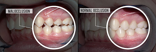 The image shows a side-by-side comparison of a person s teeth before and after dental treatment, highlighting the improvement from malocclusion to normal occlusion.