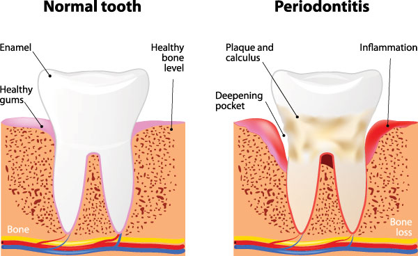 The image is a medical illustration showing the stages of tooth decay progressing from normal to periodontitis, with annotations explaining each stage.