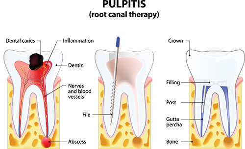 The image is a medical illustration showing the anatomy of a human tooth, including its root canal therapy, with labels indicating various parts such as the pulp, crown, nerves, and filling.