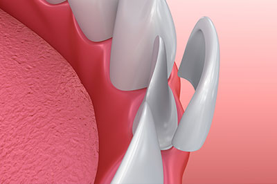 The image shows a 3D rendering of a dental implant fixture, which appears to be inserted into the jawbone with a pink gum tissue background.