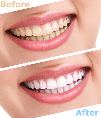 The image shows a before and after comparison of a teeth whitening treatment, with the  before  side showing yellowed teeth and the  after  side displaying bright white teeth.