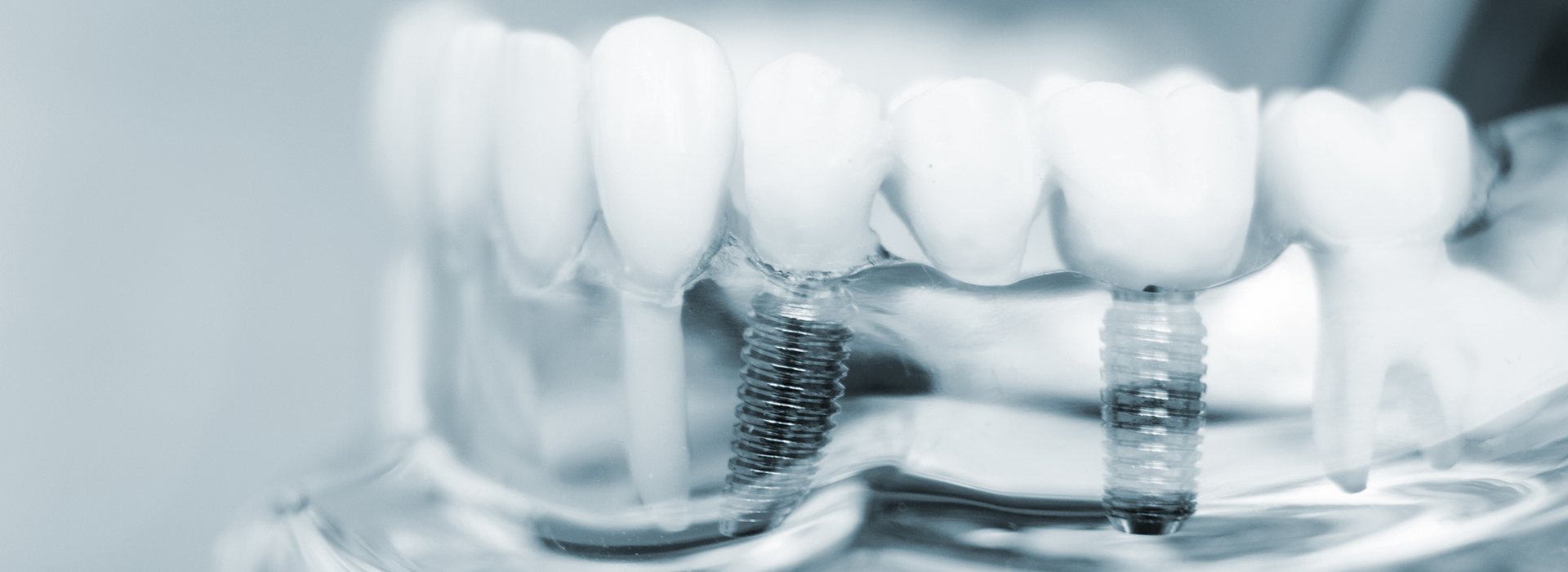 The image shows a close-up of a dental implant with a screw and abutment, likely for educational or informational purposes.