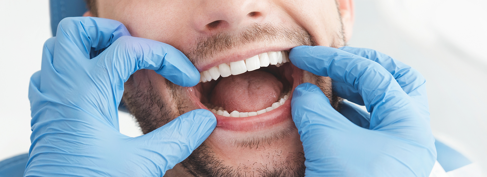 An adult male dental patient with a wide-open mouth, surrounded by blue gloves and a medical mask, indicating a dental examination or procedure.